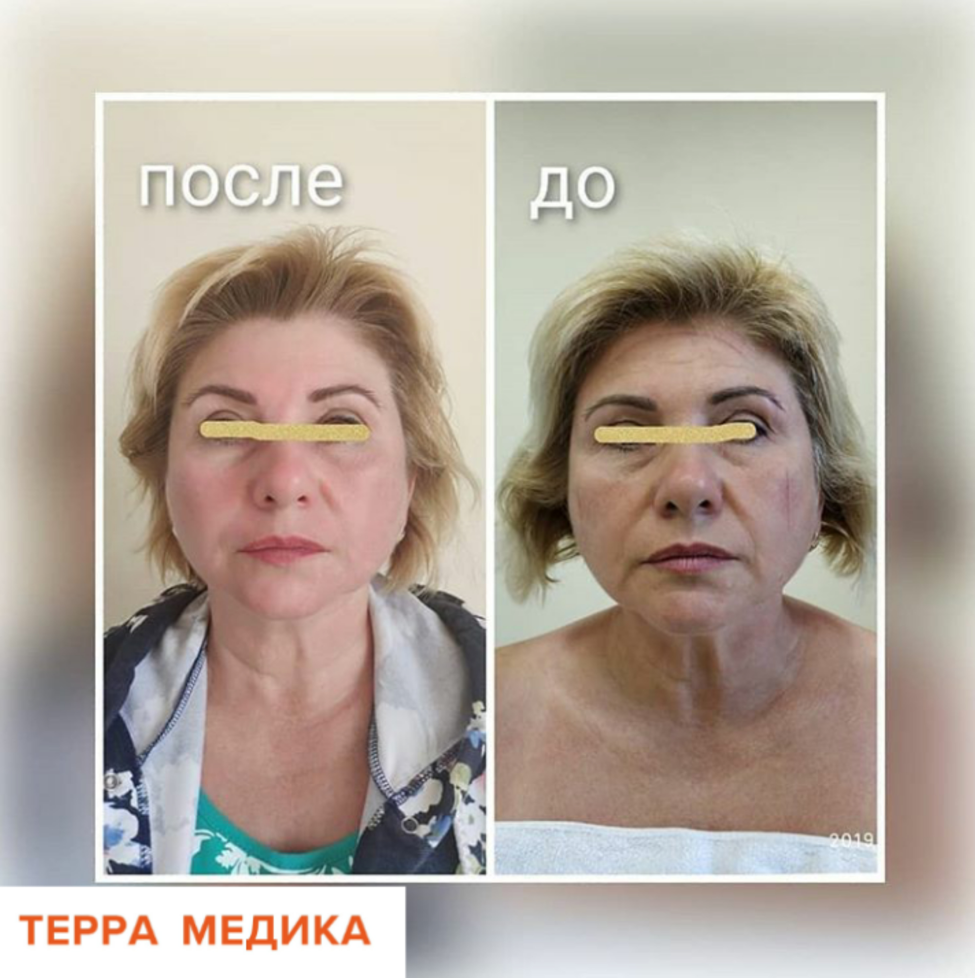 Миофасциальный омолаживающий массаж лица – эффективная альтернатива инъекциям и ботоксу!