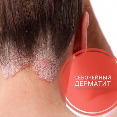 Себорейный дерматит