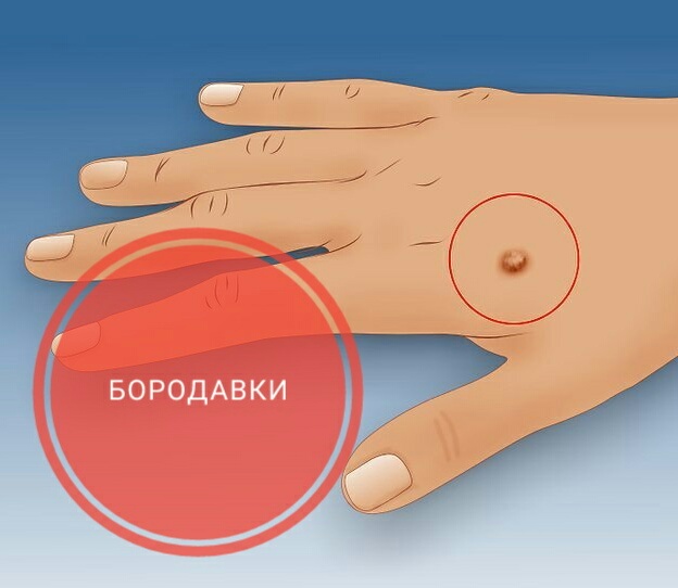 Бородавки