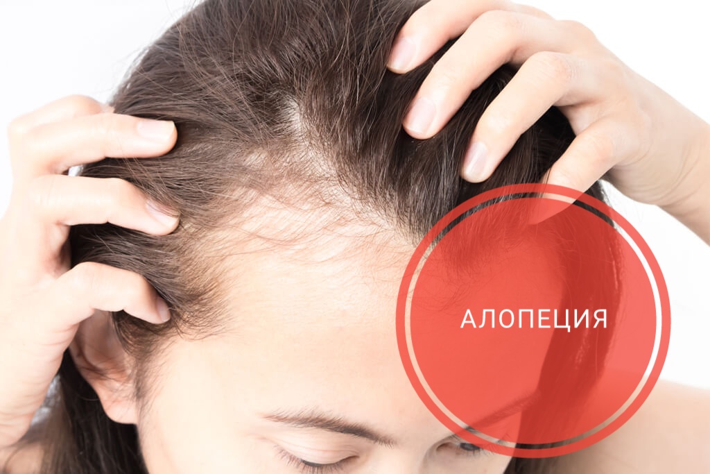 Алопеция