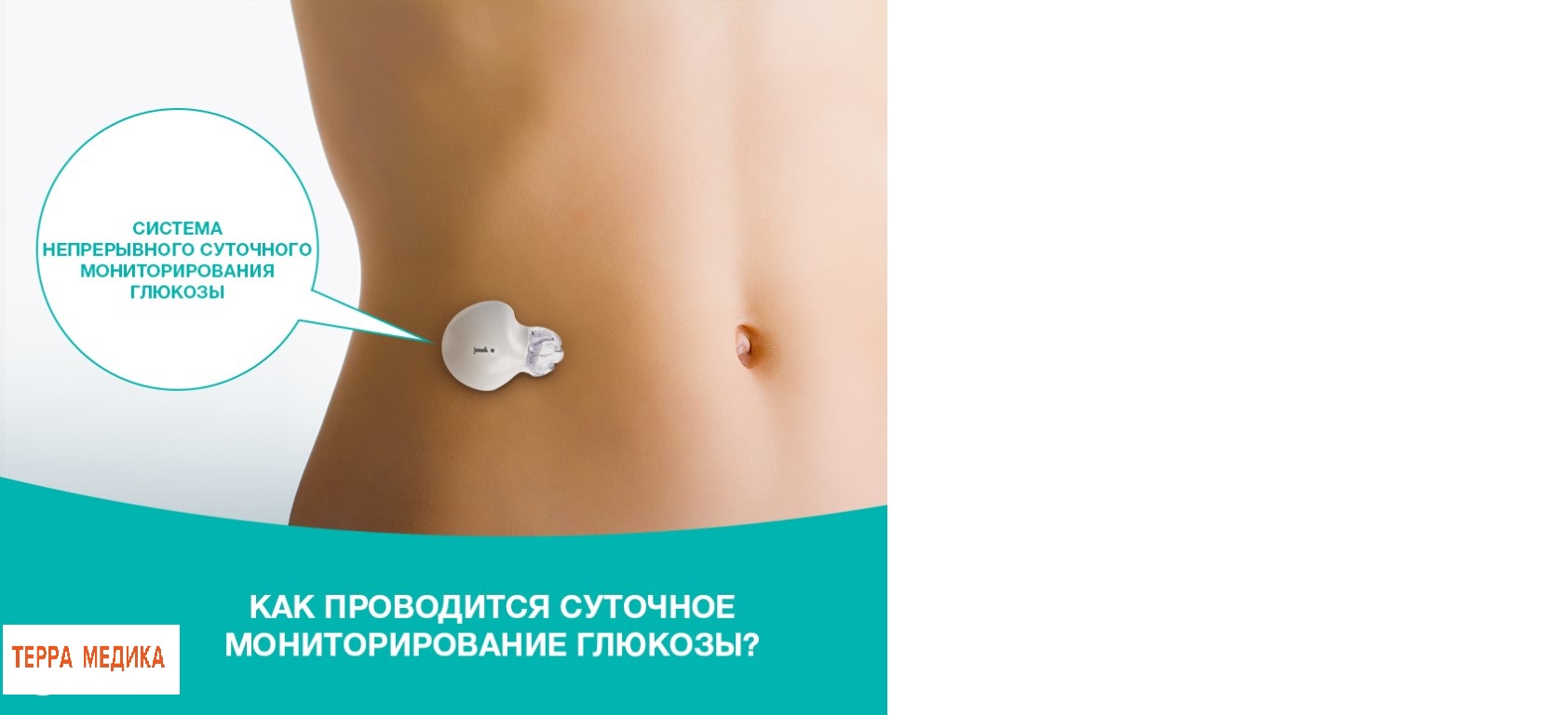 6-ти суточный мониторинг глюкозы.