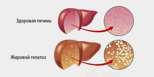 Жировой гепатоз