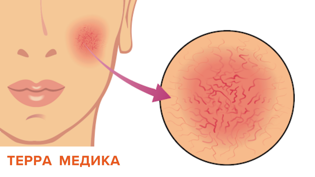 Розацеа