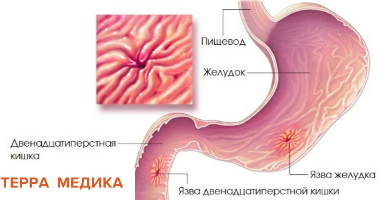 Язва двенадцатиперстной кишки