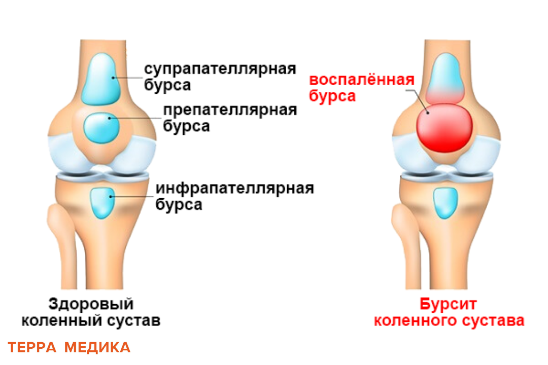 Бурсит