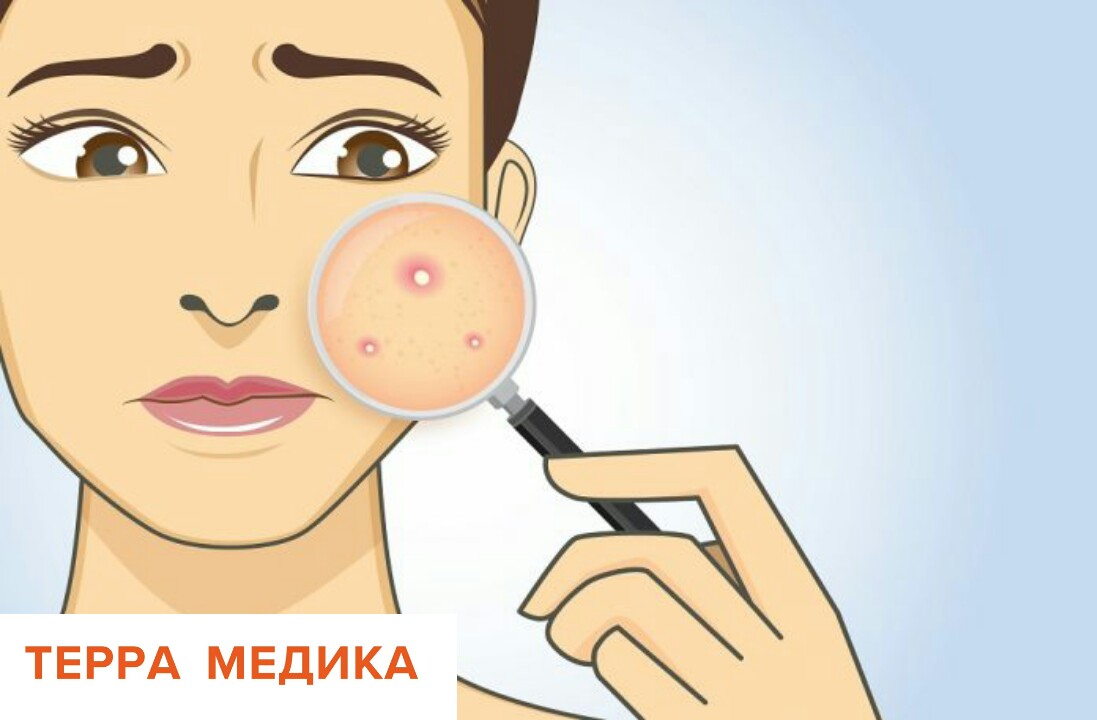 Акне