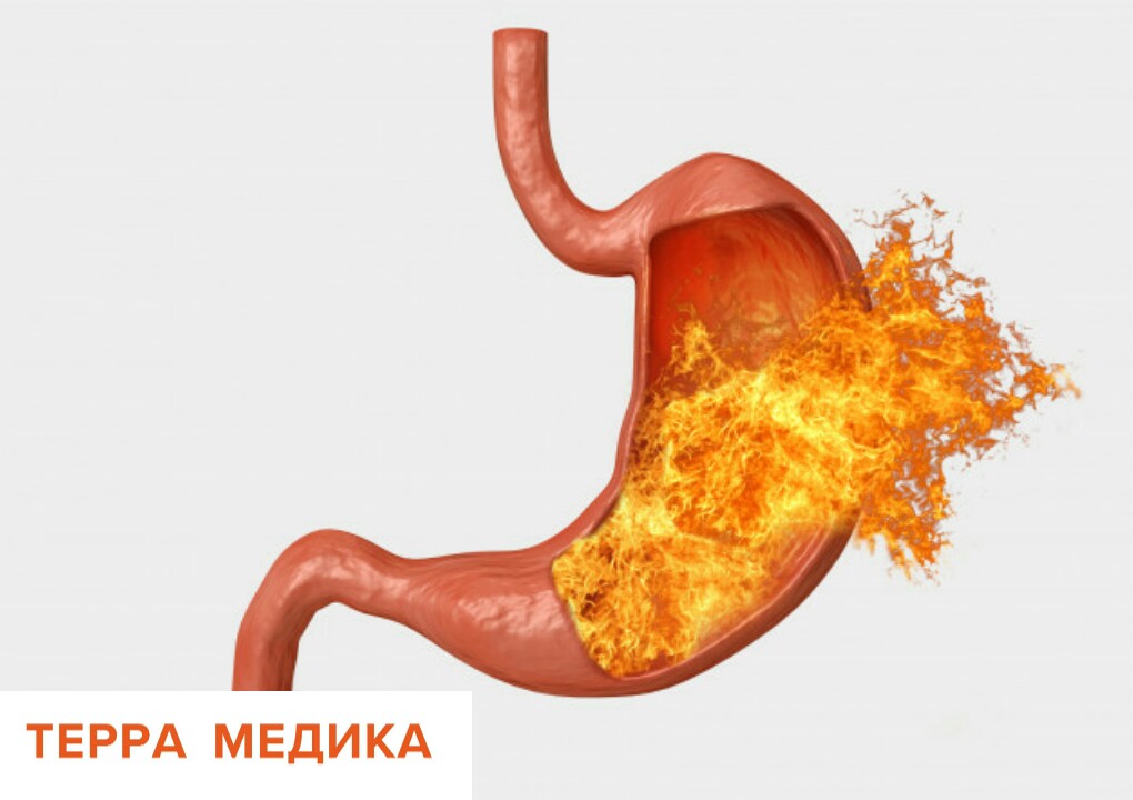 Дуоденит