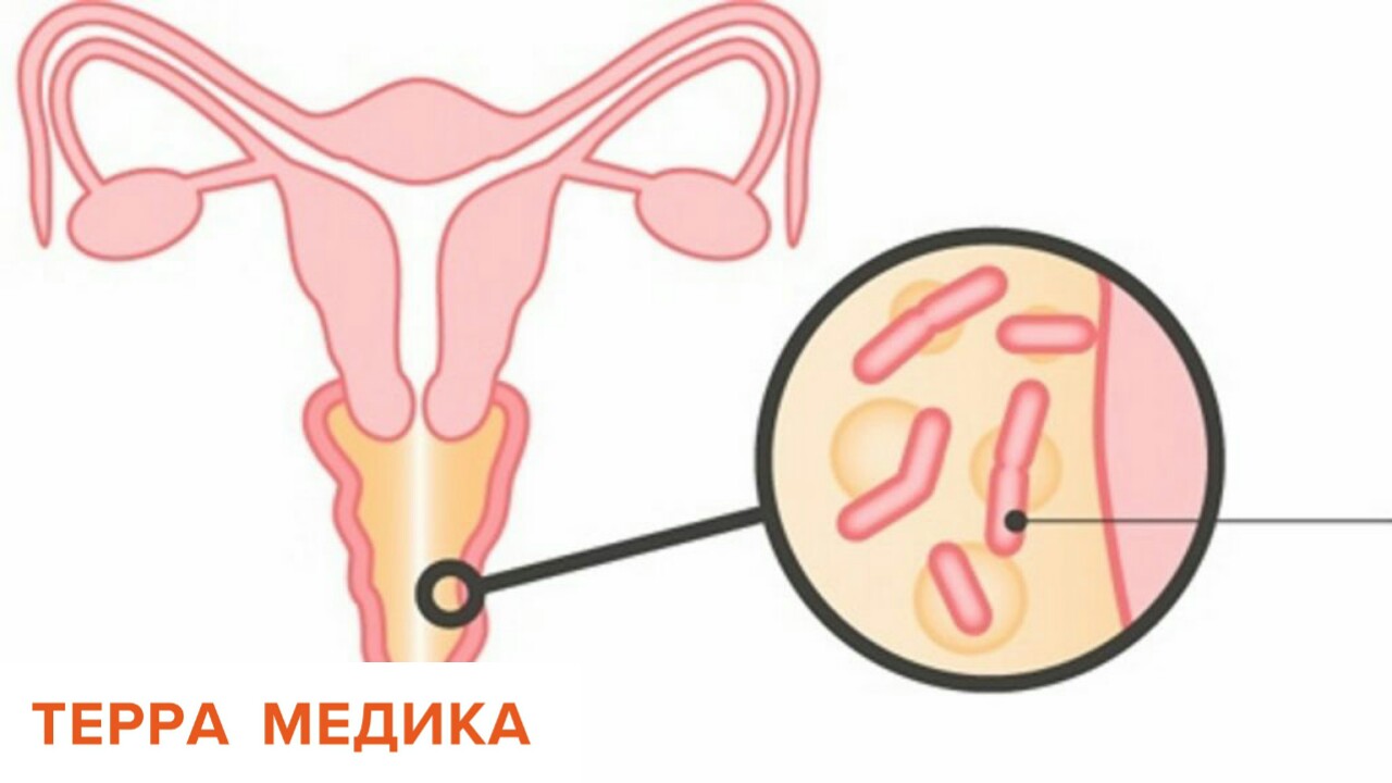 Бактериальный вагиноз