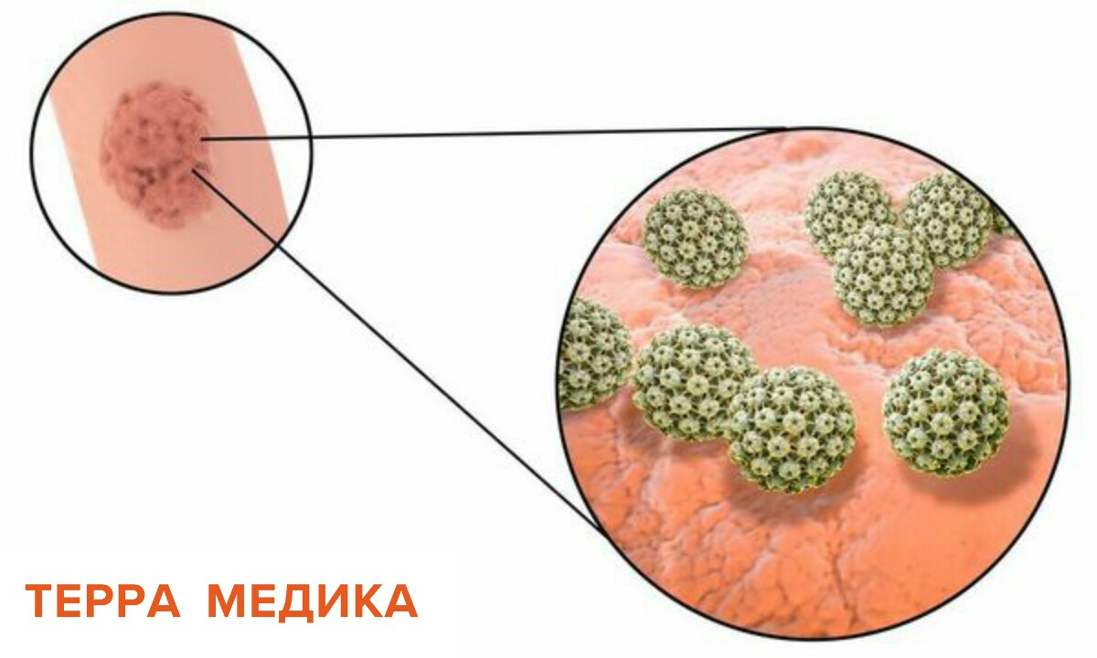 Кондиломы