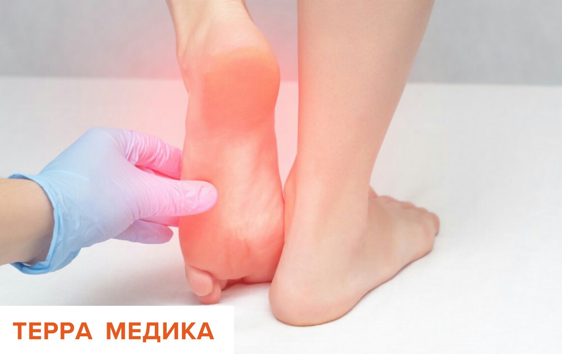 Микоз стопы