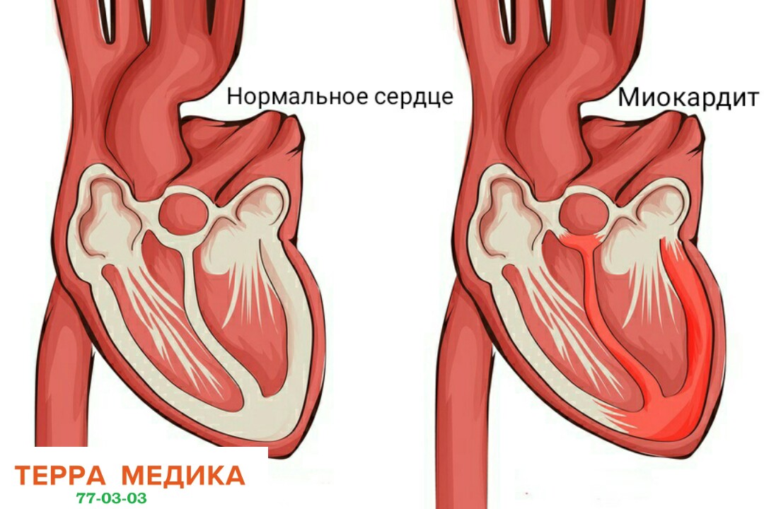 Миокардит