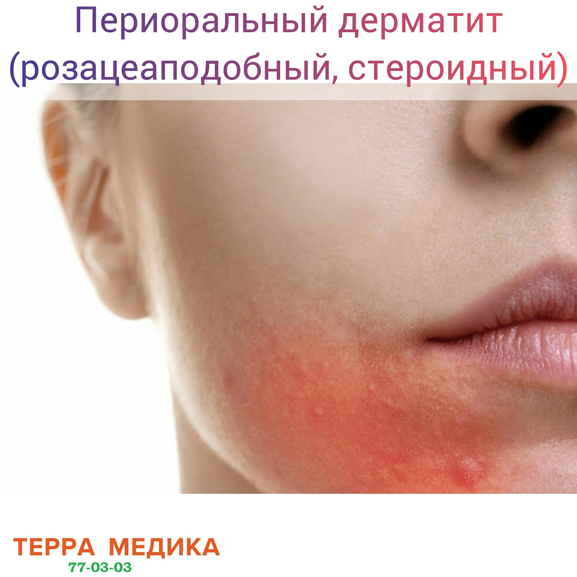 Периоральный дерматит (розацеаподобный, стероидный)