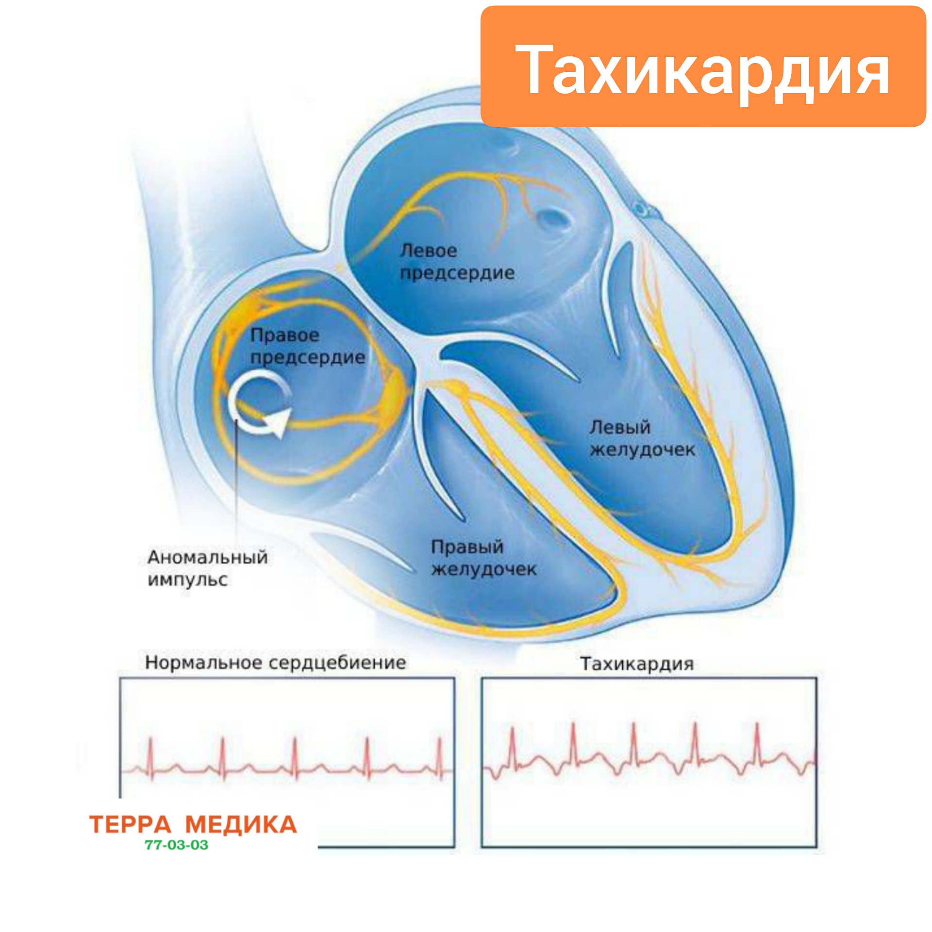 Тахикардия