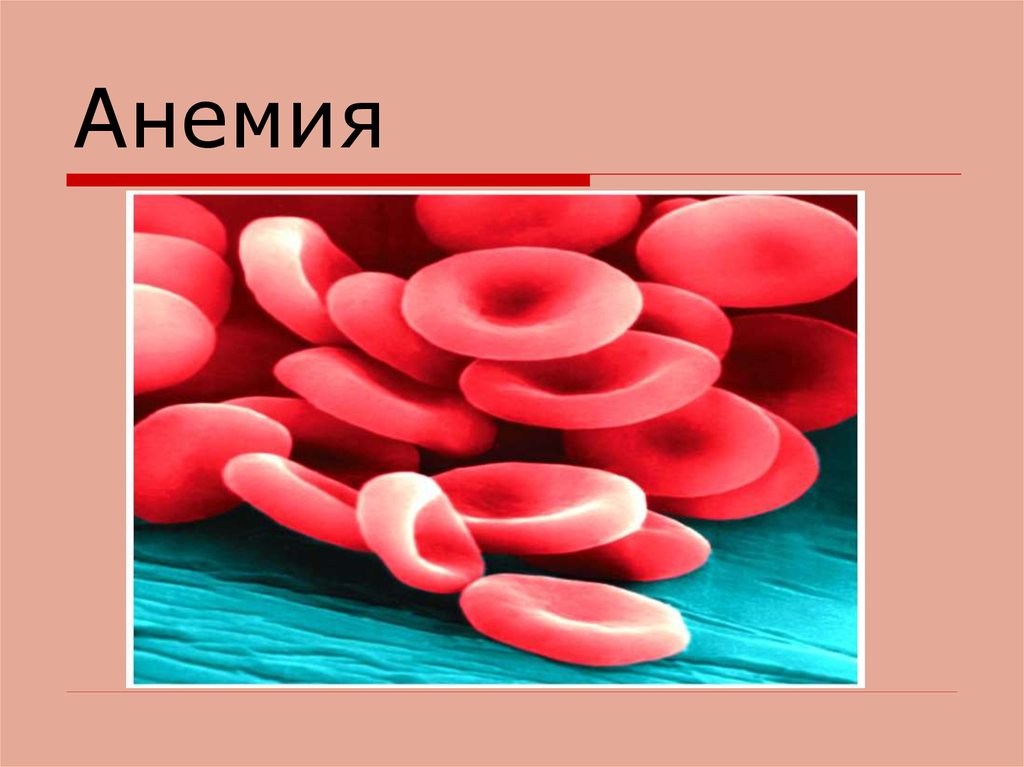 Анемия.